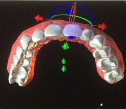 Aparelho transparente All Care Odontologia