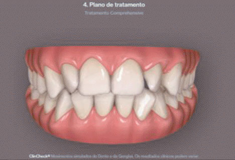 All Care Odontologia escolha seu aparelho 1